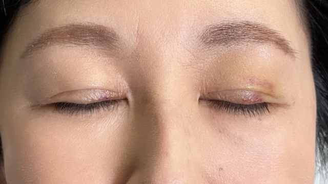 Postoperative Condition Part 1