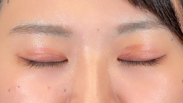 Postoperative Condition Part 1