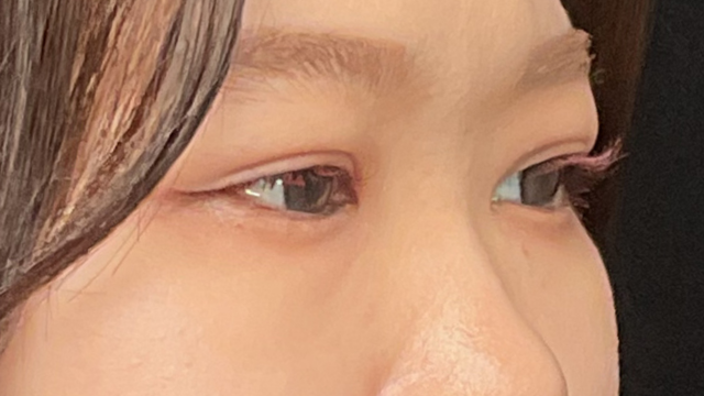 Postoperative Condition Part 1