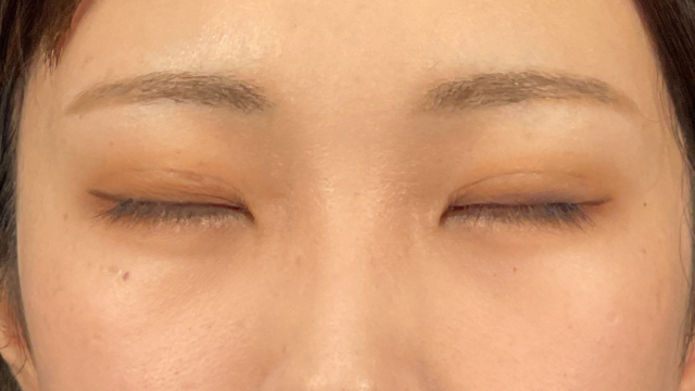 Postoperative Condition Part 1