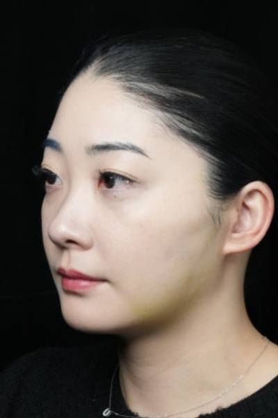 手術前の状態 その1