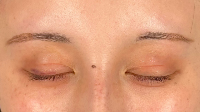 Postoperative Condition Part 1