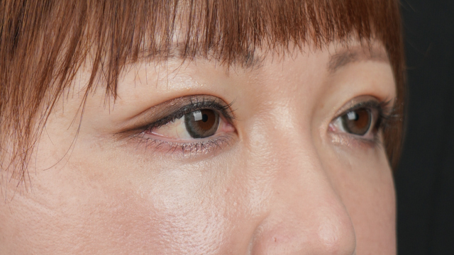 Postoperative Condition Part 1