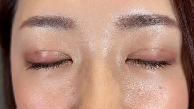 Postoperative Condition Part 1