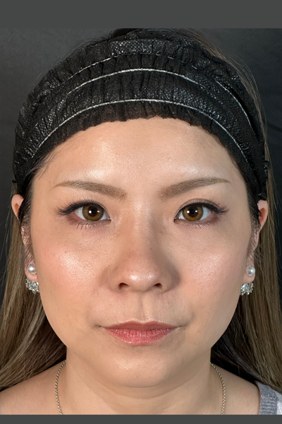 手術前の状態 その1