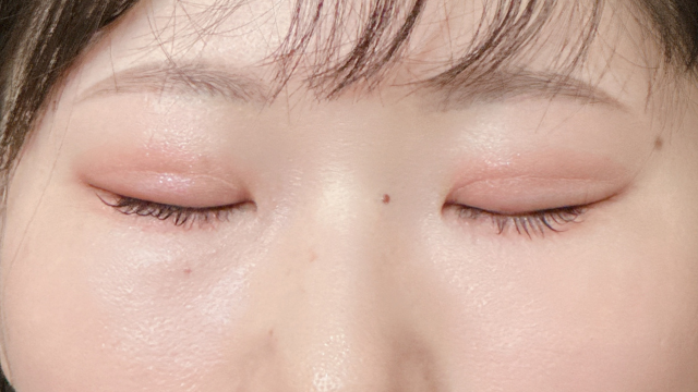 Postoperative Condition Part 1