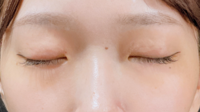 Postoperative Condition Part 1