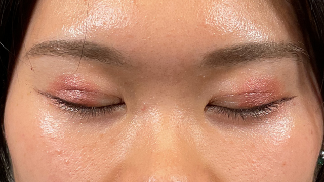 Postoperative Condition Part 1