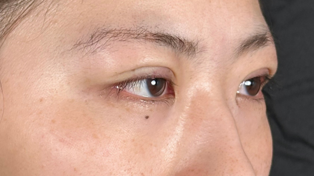 Postoperative Condition Part 1