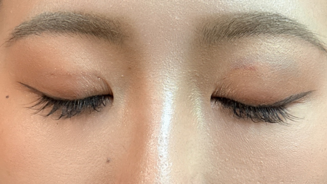 Postoperative Condition Part 1