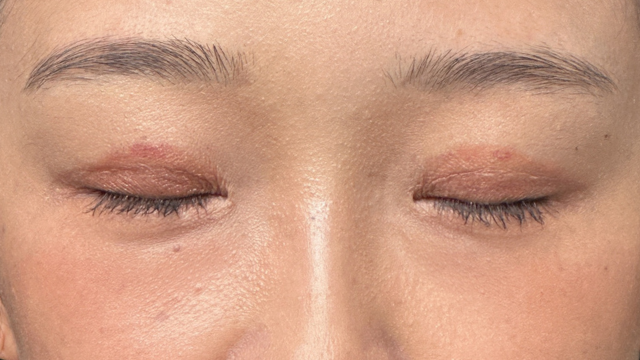 Postoperative Condition Part 1