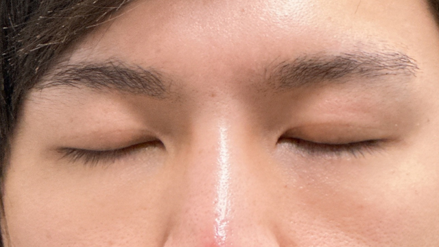 Postoperative Condition Part 1