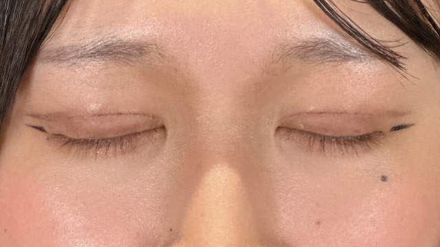 Postoperative Condition Part 1