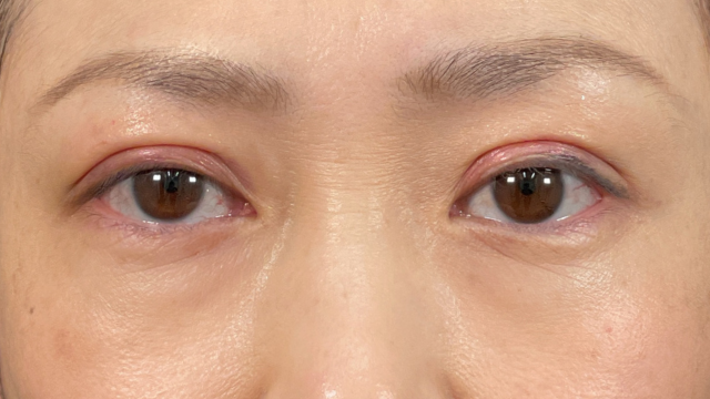 Postoperative Condition Part 1