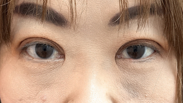 Postoperative Condition Part 1