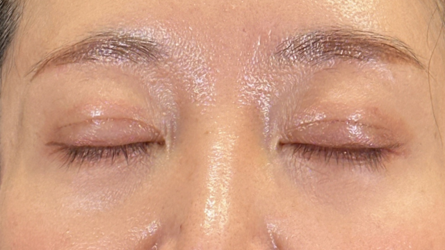 Postoperative Condition Part 1