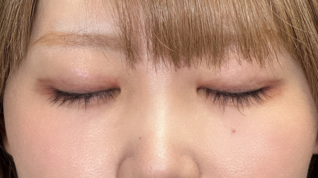 Postoperative Condition Part 1