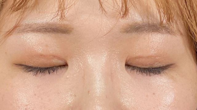 Postoperative Condition Part 1