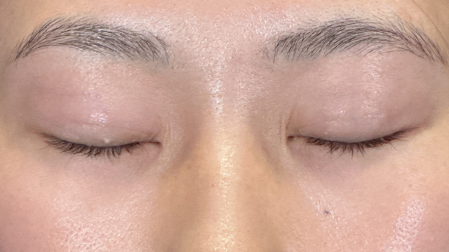 Postoperative Condition Part 1