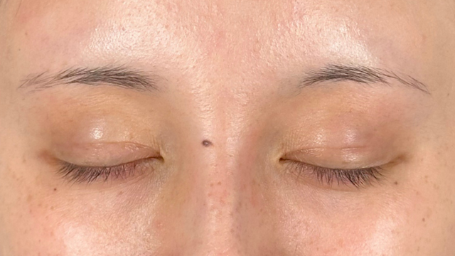 Postoperative Condition Part 1