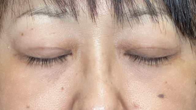 Postoperative Condition Part 1