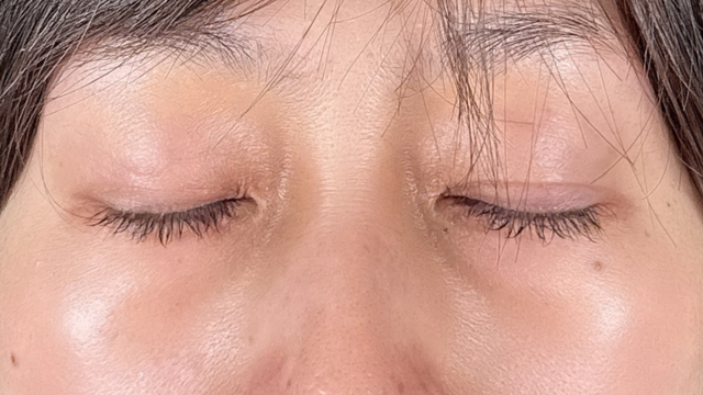 Postoperative Condition Part 1