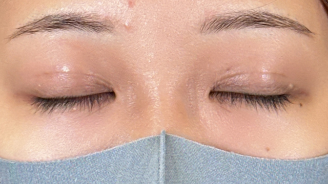 Postoperative Condition Part 1