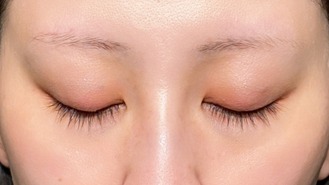 Postoperative Condition Part 1