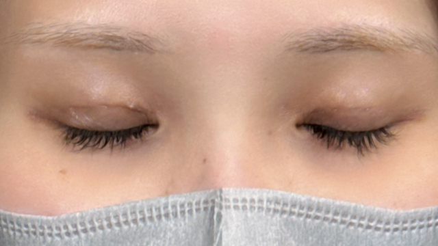 手术前的状态 其一