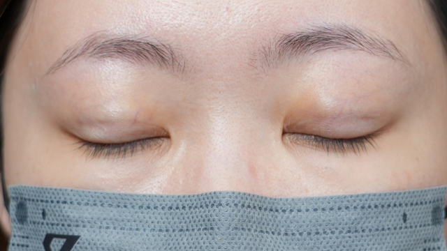 Postoperative Condition Part 1