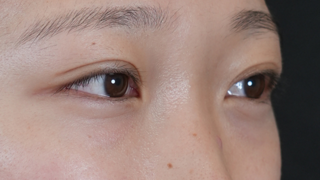 Postoperative Condition Part 1