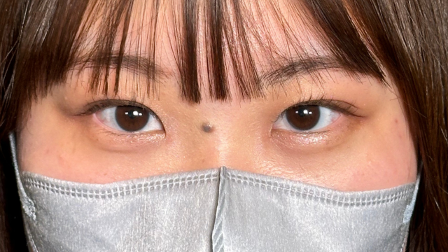 手术前的状态 其一