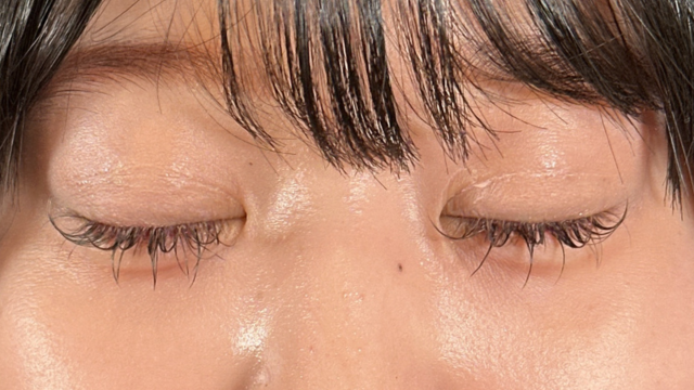 手術前の状態 その1