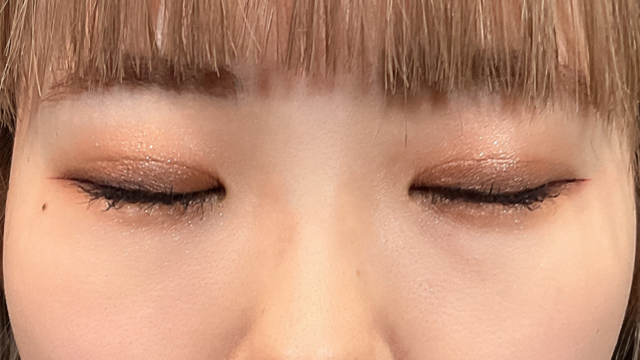 Postoperative Condition Part 1