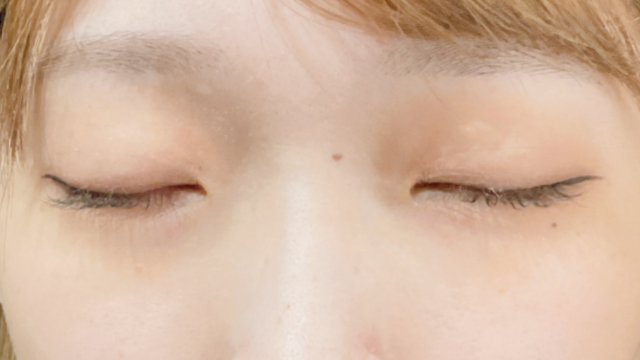 Postoperative Condition Part 1