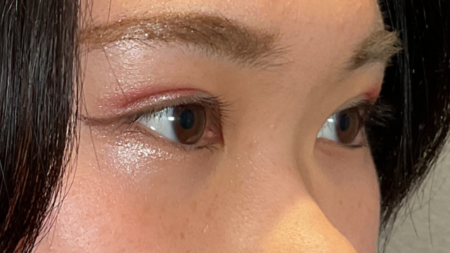 Postoperative Condition Part 1