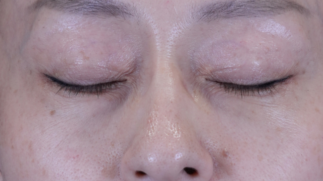 Postoperative Condition Part 1