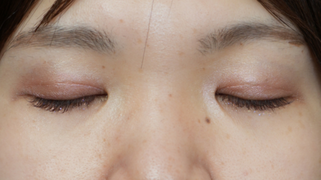 Postoperative Condition Part 1