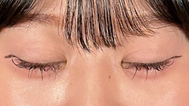 手術前の状態 その1