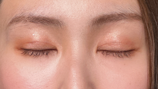 Postoperative Condition Part 1