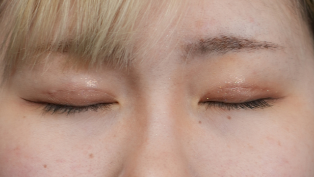 Postoperative Condition Part 1