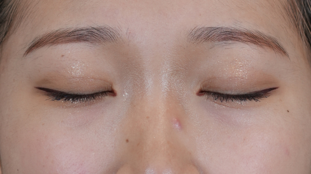 Postoperative Condition Part 1