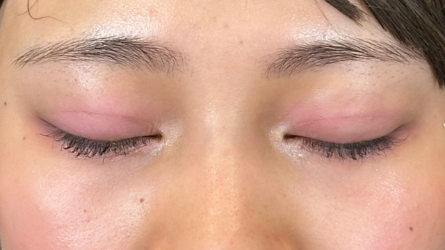 Postoperative Condition Part 1