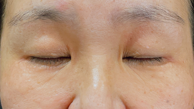 Preoperative Condition Part 1