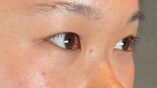 Preoperative Condition Part 1