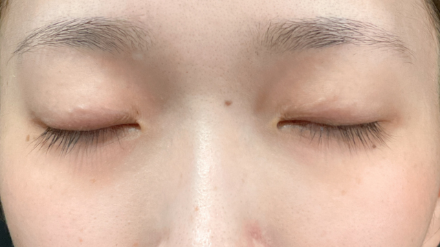 Preoperative Condition Part 1