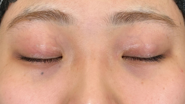 Preoperative Condition Part 1