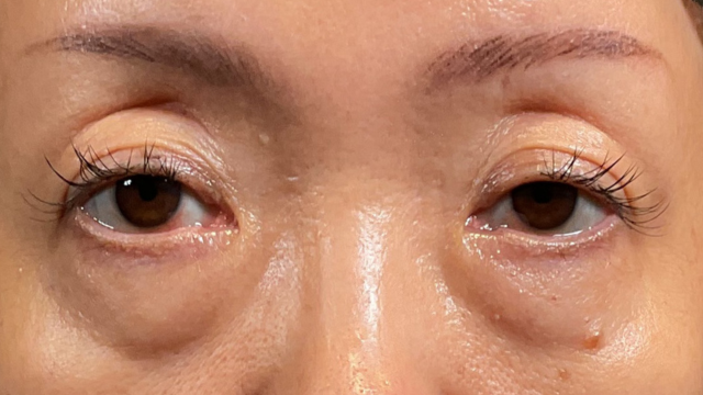 Preoperative Condition Part 1