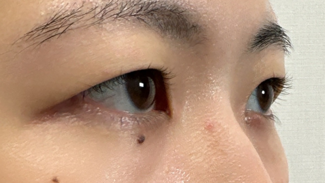 Preoperative Condition Part 1