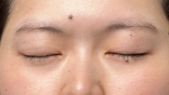 Preoperative Condition Part 1